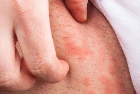 面對炎夏　異位性皮膚炎如何接招？