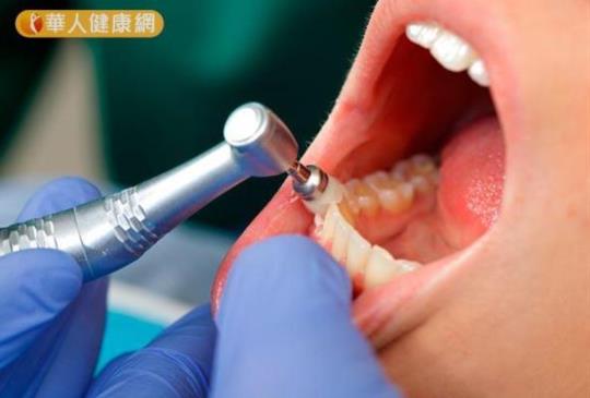 【牙齒越洗牙縫越大？牙醫破解洗牙4迷思！】